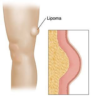 ก้อนเนื้อไขมัน หรือ เนื้องอกไขมัน (Lipoma) คืออะไร ดูแลได้อย่างไร ? ก้อนเนื้อไขมัน หรือ เนื้องอกไขมัน (Lipoma) คืออะไร ดูแลได้อย่างไร ?