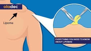 ก้อนเนื้อไขมัน หรือ เนื้องอกไขมัน (Lipoma) คืออะไร ดูแลได้อย่างไร ? ก้อนเนื้อไขมัน หรือ เนื้องอกไขมัน (Lipoma) คืออะไร ดูแลได้อย่างไร ?