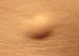 ก้อนเนื้อไขมัน หรือ เนื้องอกไขมัน (Lipoma) คืออะไร ดูแลได้อย่างไร ? ก้อนเนื้อไขมัน หรือ เนื้องอกไขมัน (Lipoma) คืออะไร ดูแลได้อย่างไร ?