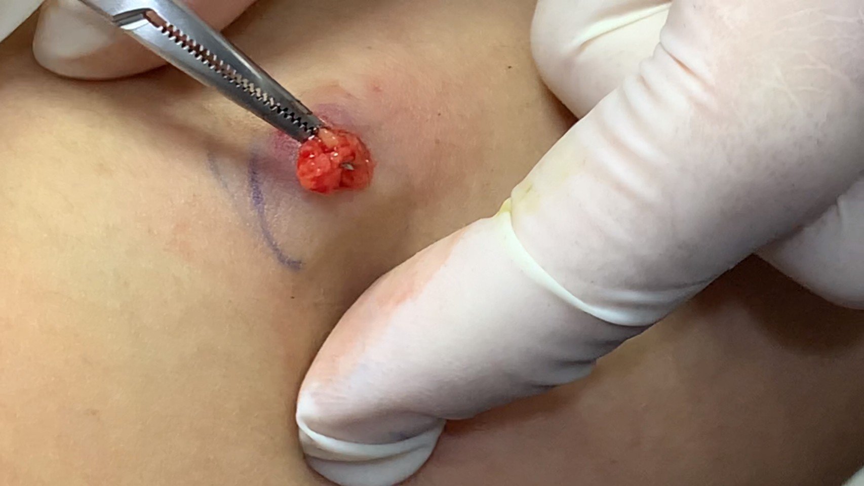 ก้อนเนื้อไขมัน หรือ เนื้องอกไขมัน (Lipoma) คืออะไร ดูแลได้อย่างไร ? ก้อนเนื้อไขมัน หรือ เนื้องอกไขมัน (Lipoma) คืออะไร ดูแลได้อย่างไร ?