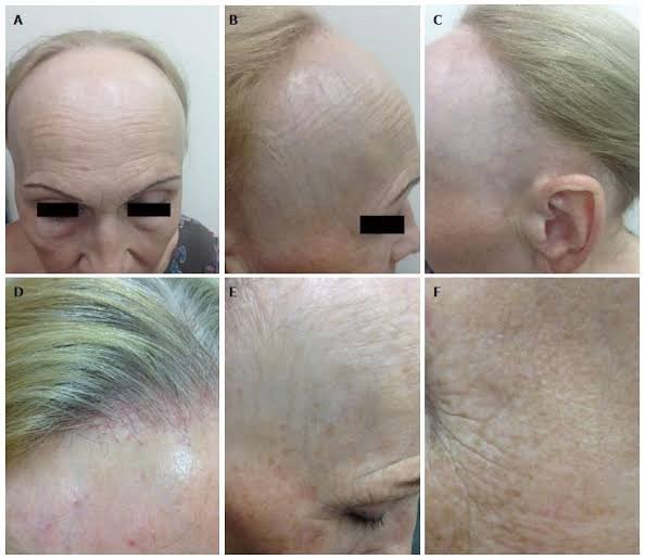 โรคผมร่วง Frontal fibrosing alopecia (FFA) คืออะไร ดูแลรักษาได้อย่างไร ? โรคผมร่วง Frontal fibrosing alopecia (FFA) คืออะไร ดูแลรักษาได้อย่างไร ?