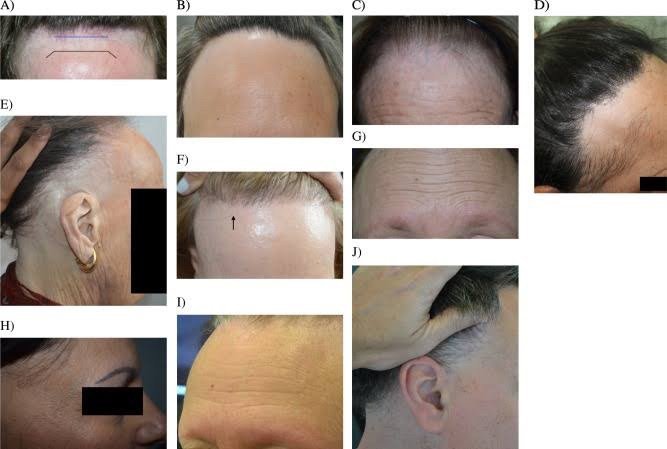 โรคผมร่วง Frontal fibrosing alopecia (FFA) คืออะไร ดูแลรักษาได้อย่างไร ? โรคผมร่วง Frontal fibrosing alopecia (FFA) คืออะไร ดูแลรักษาได้อย่างไร ?