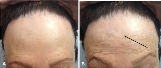 โรคผมร่วง Frontal fibrosing alopecia (FFA) คืออะไร ดูแลรักษาได้อย่างไร ? โรคผมร่วง Frontal fibrosing alopecia (FFA) คืออะไร ดูแลรักษาได้อย่างไร ?