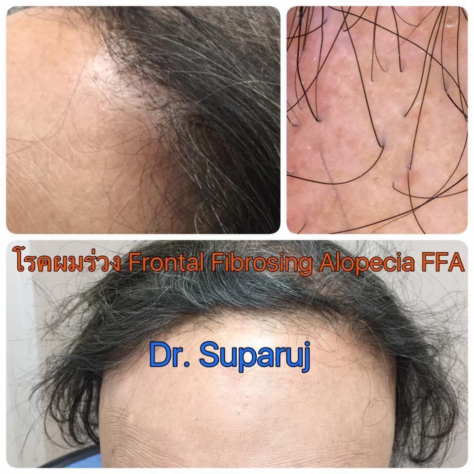โรคผมร่วง Frontal fibrosing alopecia (FFA) คืออะไร ดูแลรักษาได้อย่างไร ? โรคผมร่วง Frontal fibrosing alopecia (FFA) คืออะไร ดูแลรักษาได้อย่างไร ?