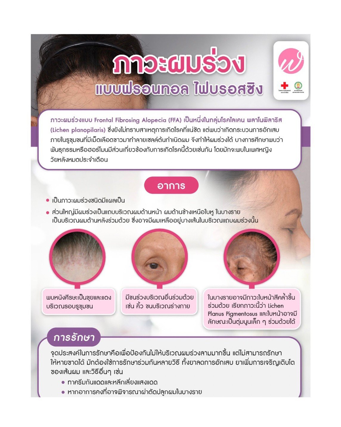 โรคผมร่วง Frontal fibrosing alopecia (FFA) คืออะไร ดูแลรักษาได้อย่างไร ? โรคผมร่วง Frontal fibrosing alopecia (FFA) คืออะไร ดูแลรักษาได้อย่างไร ?