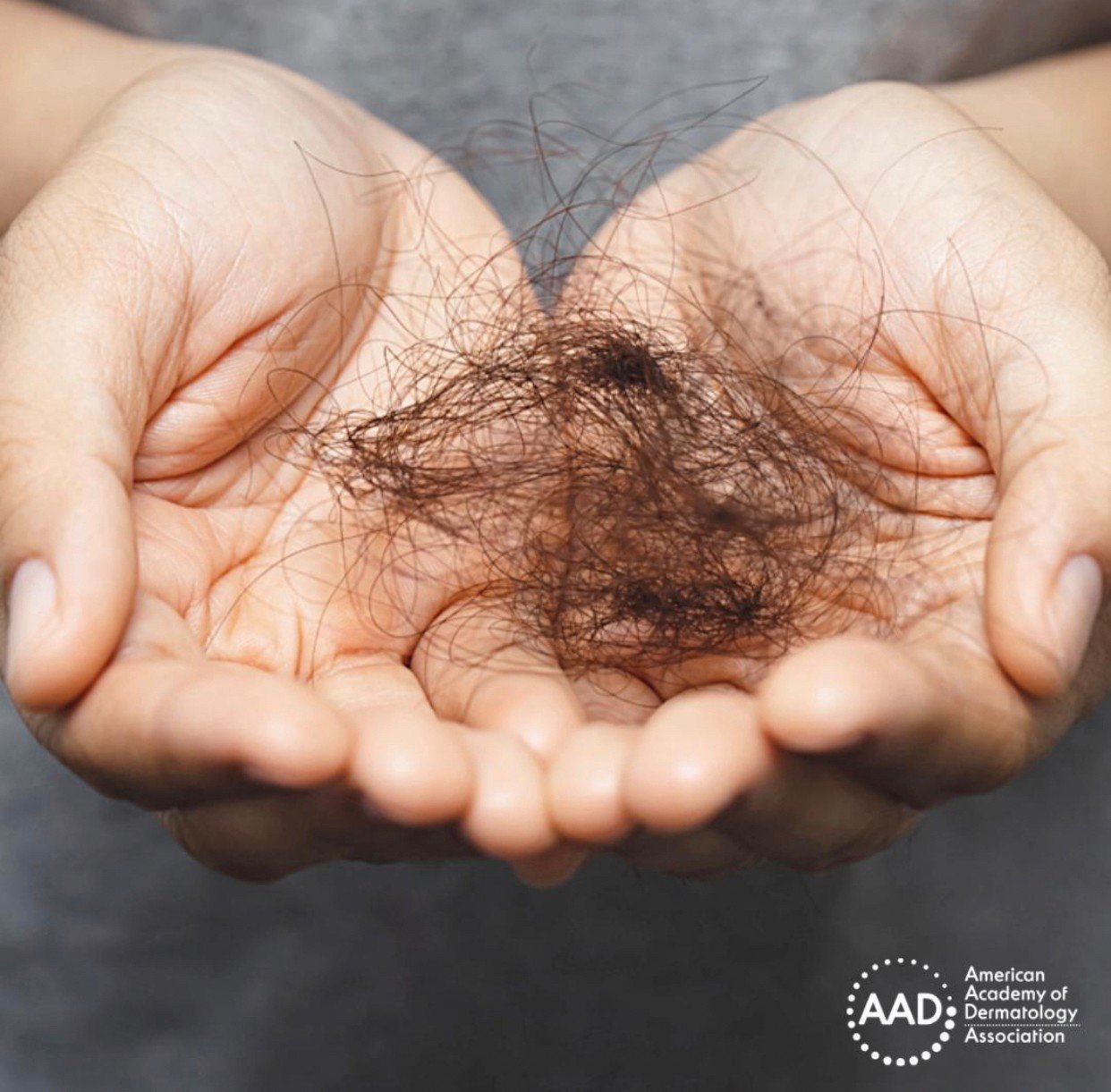 ผมร่วงทั่วศีรษะ (Telogen Effluvium) คืออะไร รักษาได้อย่างไร? ผมร่วงทั่วศีรษะ (Telogen Effluvium) คืออะไร รักษาได้อย่างไร?