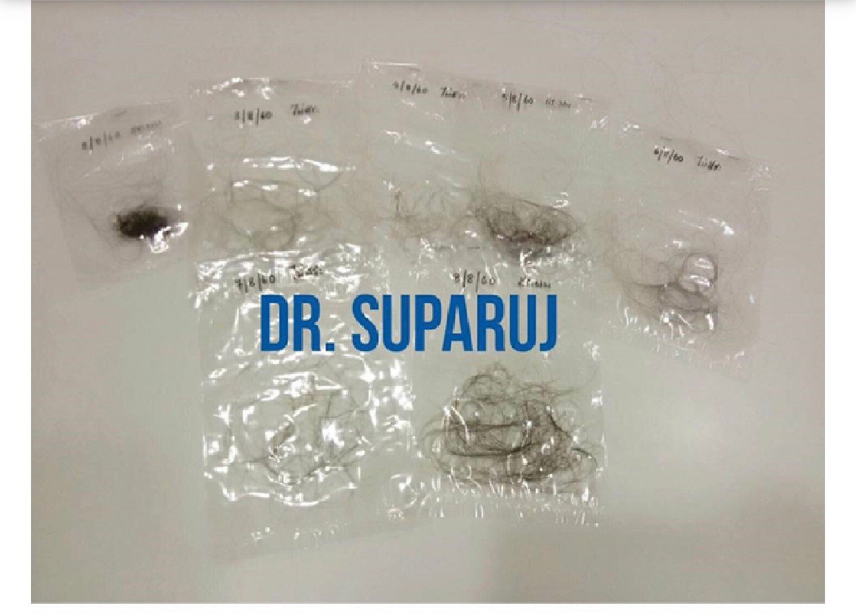 ผมร่วงทั่วศีรษะ (Telogen Effluvium) คืออะไร รักษาได้อย่างไร? ผมร่วงทั่วศีรษะ (Telogen Effluvium) คืออะไร รักษาได้อย่างไร?