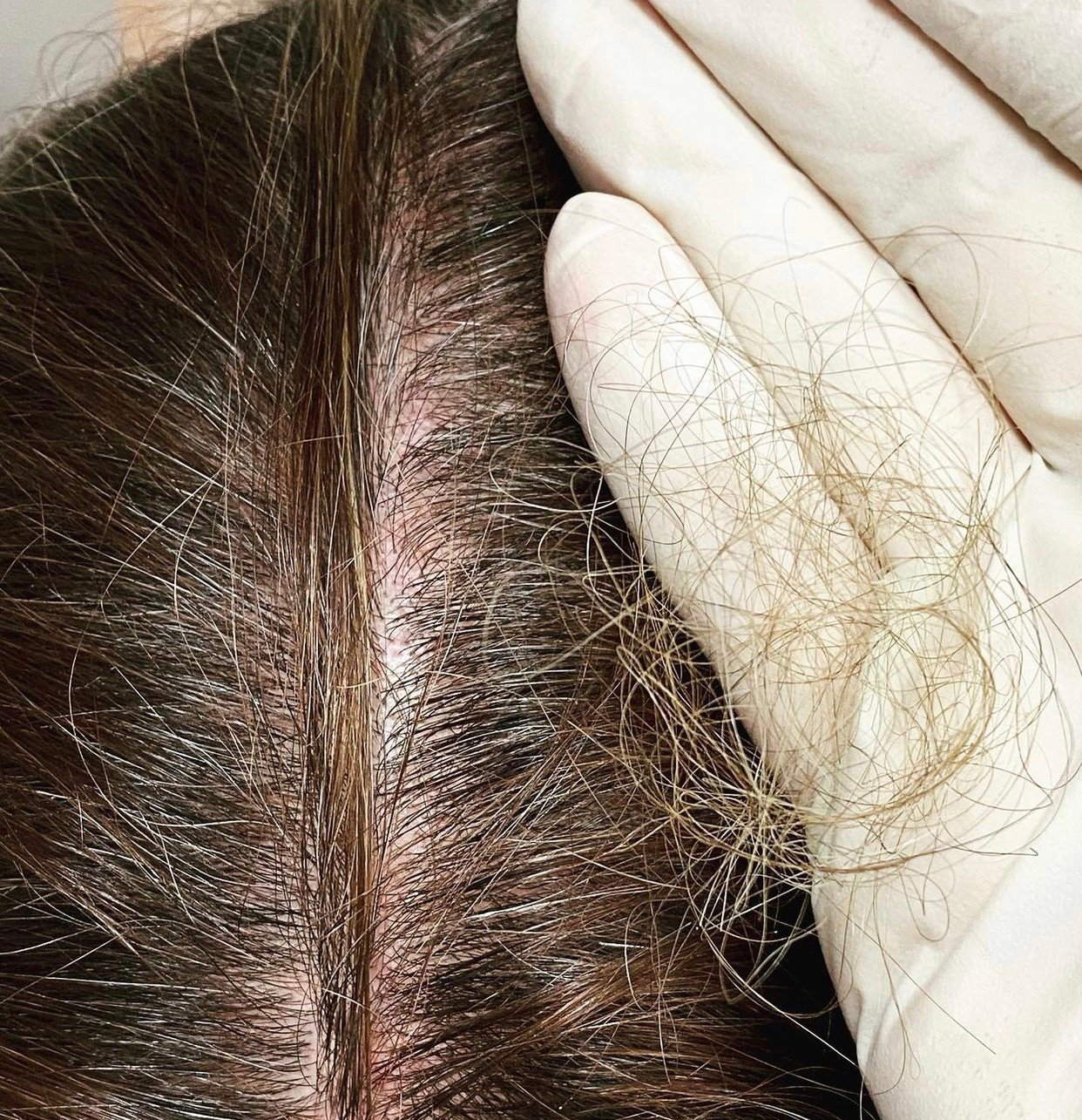 ผมร่วงทั่วศีรษะ (Telogen Effluvium) คืออะไร รักษาได้อย่างไร? ผมร่วงทั่วศีรษะ (Telogen Effluvium) คืออะไร รักษาได้อย่างไร?