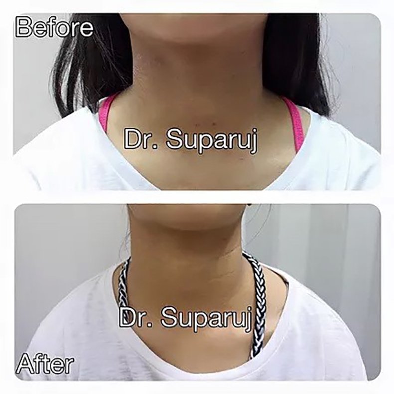 โรคผื่นภูมิแพ้ผิวหนังในเด็ก – สาเหตุและการปกป้องผิวแพ้ง่าย โดยรองศาสตราจารย์ นายแพทย์ เทอดพงศ์ เต็มภาคย์ โรคผื่นภูมิแพ้ผิวหนังในเด็ก – สาเหตุและการปกป้องผิวแพ้ง่าย โดยรองศาสตราจารย์ นายแพทย์ เทอดพงศ์ เต็มภาคย์