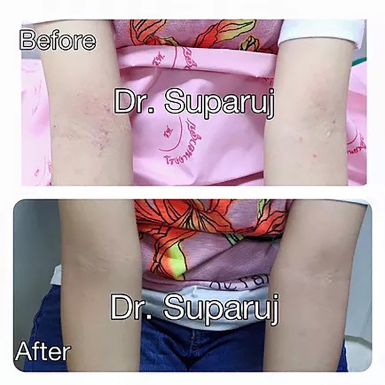 โรคผื่นภูมิแพ้ผิวหนังในเด็ก – สาเหตุและการปกป้องผิวแพ้ง่าย โดยรองศาสตราจารย์ นายแพทย์ เทอดพงศ์ เต็มภาคย์ โรคผื่นภูมิแพ้ผิวหนังในเด็ก – สาเหตุและการปกป้องผิวแพ้ง่าย โดยรองศาสตราจารย์ นายแพทย์ เทอดพงศ์ เต็มภาคย์