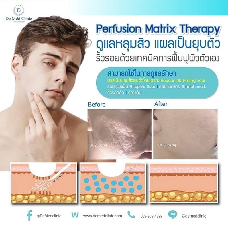 Perfusion Matrix Therapy ดูแลหลุมสิว แผลเป็นยุบตัว ริ้วรอยด้วยเทคนิคการฟื้นฟูจากภายในผิวตัวเอง Perfusion Matrix Therapy ดูแลหลุมสิว แผลเป็นยุบตัว ริ้วรอยด้วยเทคนิคการฟื้นฟูจากภายในผิวตัวเอง