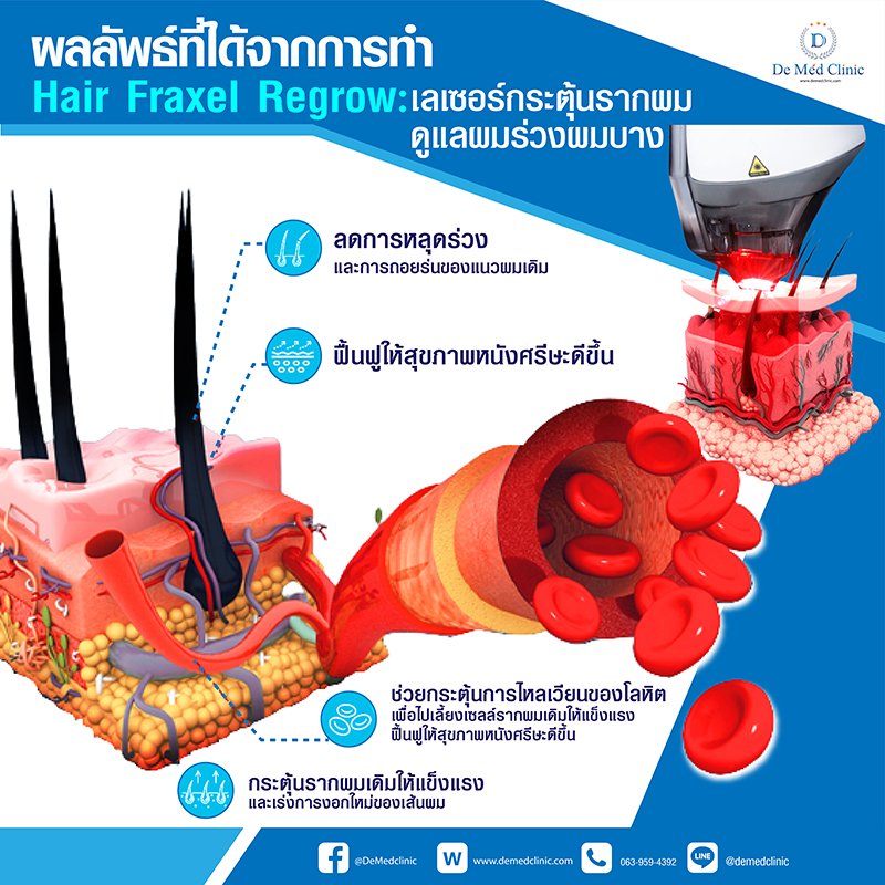 Hair Fraxel Regrow: เลเซอร์กระตุ้นรากผม ดูแลผมร่วงผมบาง Hair Fraxel Regrow: เลเซอร์กระตุ้นรากผม ดูแลผมร่วงผมบาง