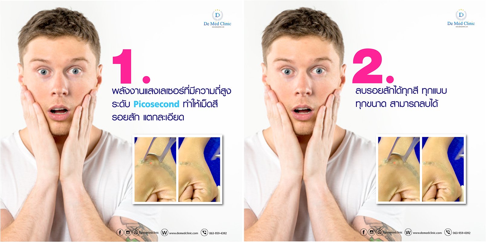 ลบรอยสัก อย่างมีประสิทธิภาพด้วยPicosecond Laser ***พิเศษ เริ่มต้น 1,000 บาท***