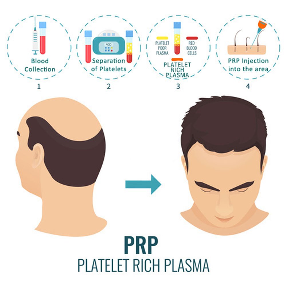 เกล็ดเลือดเข้มข้น PRP Platelet-rich plasma คืออะไร ?