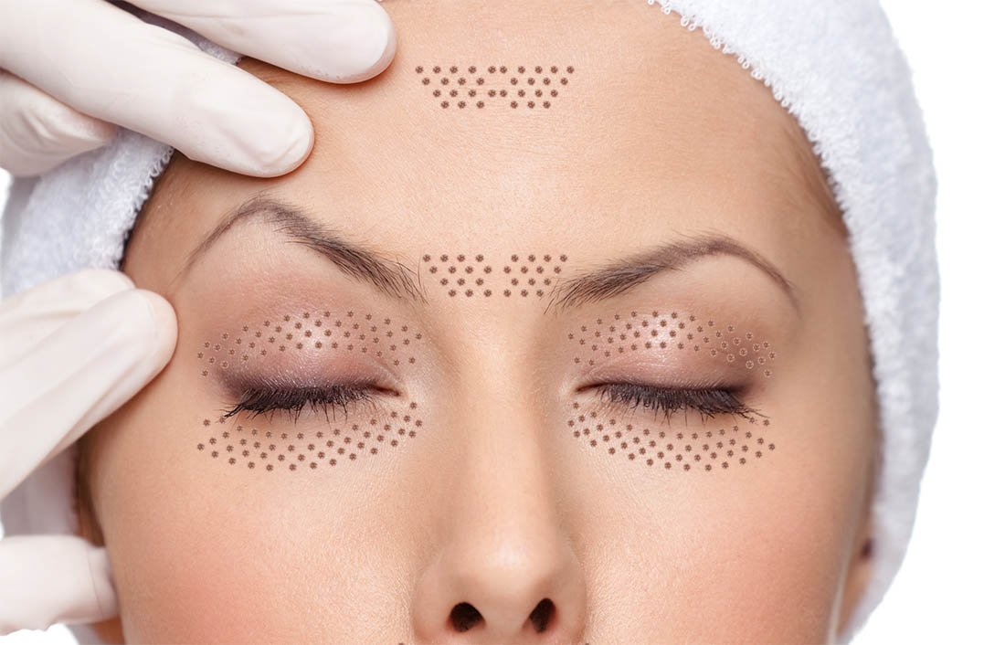 หนังตาตก คิ้วตก แก้ได้ไม่ต้องผ่าตัด ด้วยเลเซอร์แก้ไขหนังตาตก หนังตาตก คิ้วตก แก้ได้ไม่ต้องผ่าตัด ด้วยเลเซอร์แก้ไขหนังตาตก