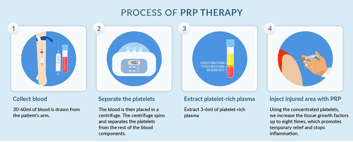 เกล็ดเลือดเข้มข้น PRP Platelet-rich plasma คืออะไร ?