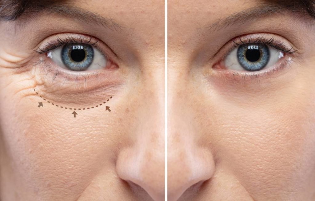 หนังตาตก คิ้วตก แก้ได้ไม่ต้องผ่าตัด ด้วยเลเซอร์แก้ไขหนังตาตก หนังตาตก คิ้วตก แก้ได้ไม่ต้องผ่าตัด ด้วยเลเซอร์แก้ไขหนังตาตก