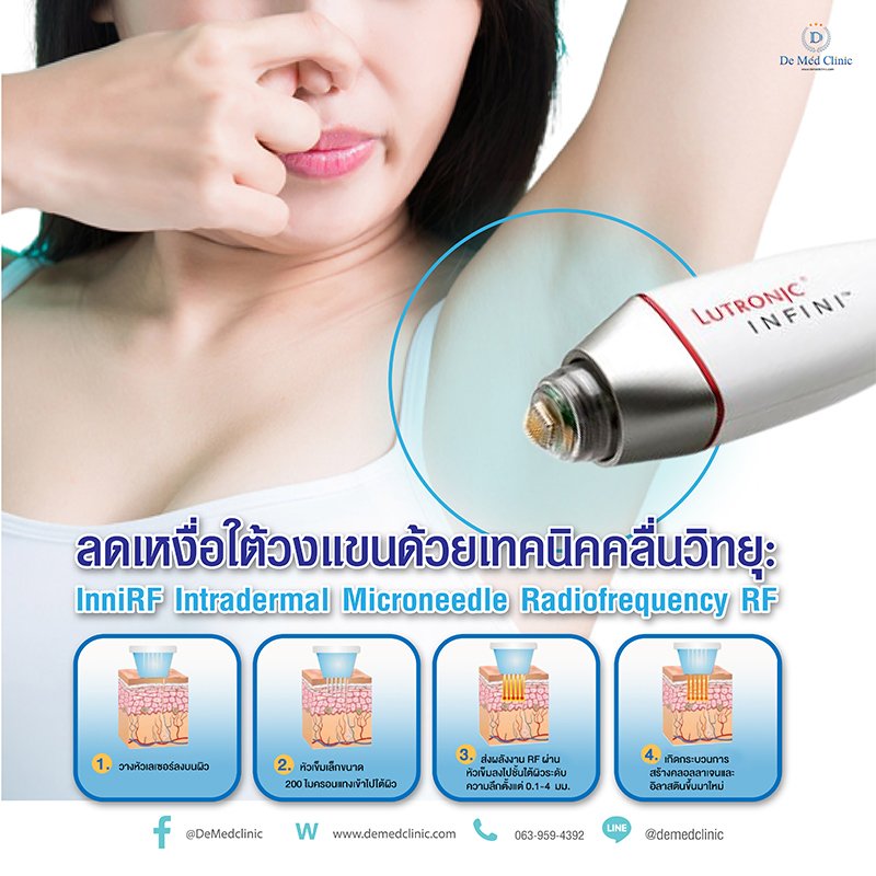 ลดเหงื่อใต้วงแขนด้วยเทคนิคคลื่นวิทยุ RF: InfiniRF Intradermal Microneedle Radiofrequency ลดเหงื่อใต้วงแขนด้วยเทคนิคคลื่นวิทยุ RF: InfiniRF Intradermal Microneedle Radiofrequency