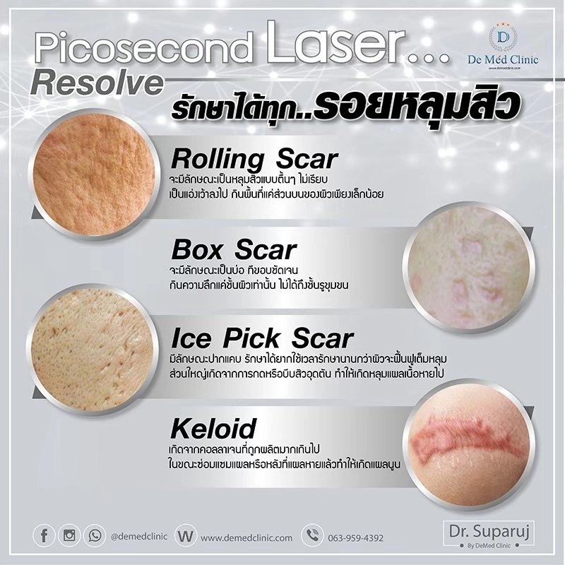 รักษาหลุมสิวด้วยเลเซอร์ Picosecond Laser และ Fractional CO2 Laser มีเทคนิคต่างกันอย่างไร ชนิดไหนได้ผลดีกว่า?