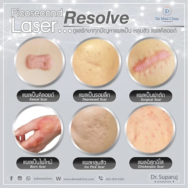 รักษาหลุมสิวด้วยเลเซอร์ Picosecond Laser และ Fractional CO2 Laser มีเทคนิคต่างกันอย่างไร ชนิดไหนได้ผลดีกว่า?