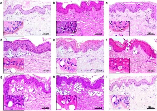 ดูแลหลุมสิว แผลเป็น รอยแตกลาย ด้วย Picosecond Laser เทคนิคเลนส์พิเศษ Micro Lens Array(MLA) ดูแลหลุมสิว แผลเป็น รอยแตกลาย ด้วย Picosecond Laser เทคนิคเลนส์พิเศษ Micro Lens Array(MLA)