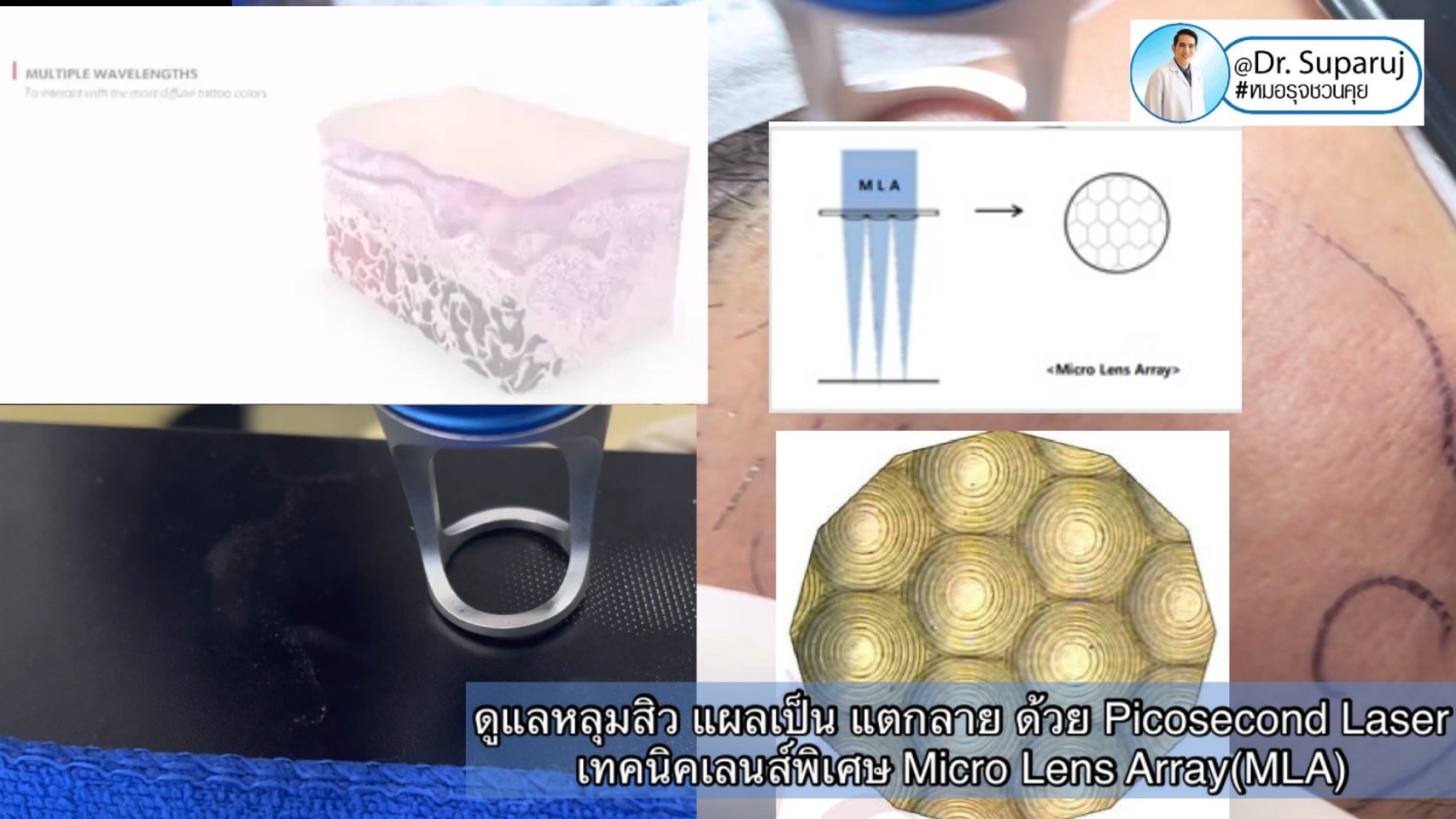 ดูแลหลุมสิว แผลเป็น รอยแตกลาย ด้วย Picosecond Laser เทคนิคเลนส์พิเศษ Micro Lens Array(MLA) ดูแลหลุมสิว แผลเป็น รอยแตกลาย ด้วย Picosecond Laser เทคนิคเลนส์พิเศษ Micro Lens Array(MLA)