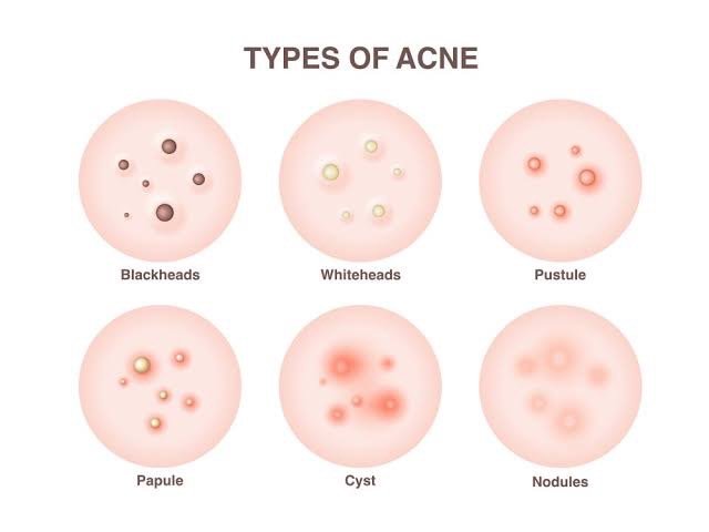 แนะนำเทคนิคดูแลโรคผิวหนัง Ep.4: สิวมี่กี่ชนิด รู้แล้วสำคัญอย่างไร Acne Type? แนะนำเทคนิคดูแลโรคผิวหนัง Ep.4: สิวมี่กี่ชนิด รู้แล้วสำคัญอย่างไร Acne Type?