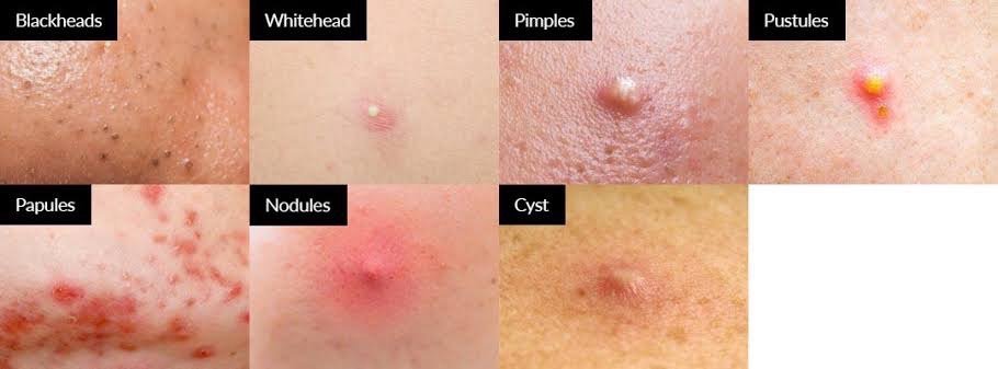 แนะนำเทคนิคดูแลโรคผิวหนัง Ep.4: สิวมี่กี่ชนิด รู้แล้วสำคัญอย่างไร Acne Type? แนะนำเทคนิคดูแลโรคผิวหนัง Ep.4: สิวมี่กี่ชนิด รู้แล้วสำคัญอย่างไร Acne Type?