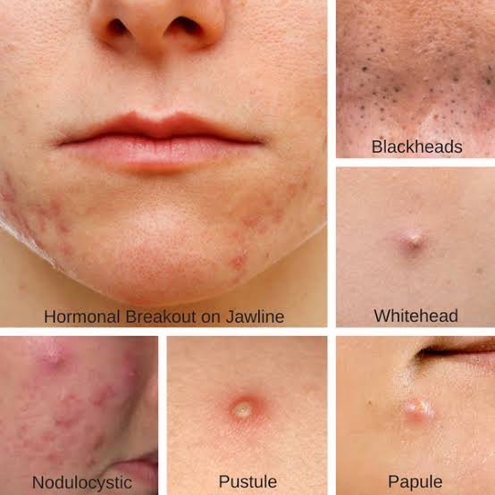 แนะนำเทคนิคดูแลโรคผิวหนัง Ep.4: สิวมี่กี่ชนิด รู้แล้วสำคัญอย่างไร Acne Type?