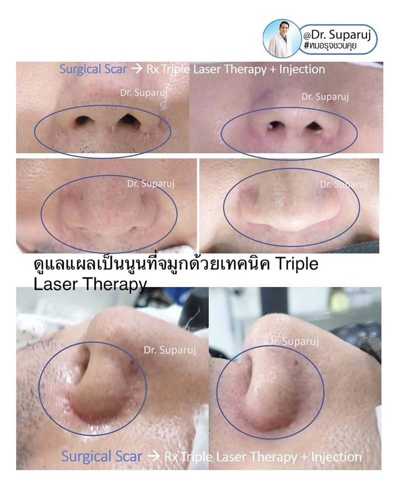 แนะนำเทคนิคดูแลหลุมสิว : แผลเป็นหลุมสิวที่จมูก ดูแลได้อย่างไรบ้าง ? แนะนำเทคนิคดูแลหลุมสิว : แผลเป็นหลุมสิวที่จมูก ดูแลได้อย่างไรบ้าง ?