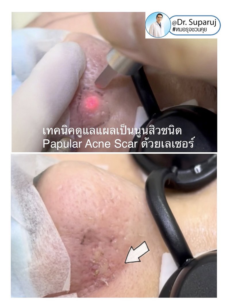 แนะนำเทคนิคดูแลหลุมสิว : แผลเป็นหลุมสิวที่จมูก ดูแลได้อย่างไรบ้าง ? แนะนำเทคนิคดูแลหลุมสิว : แผลเป็นหลุมสิวที่จมูก ดูแลได้อย่างไรบ้าง ?