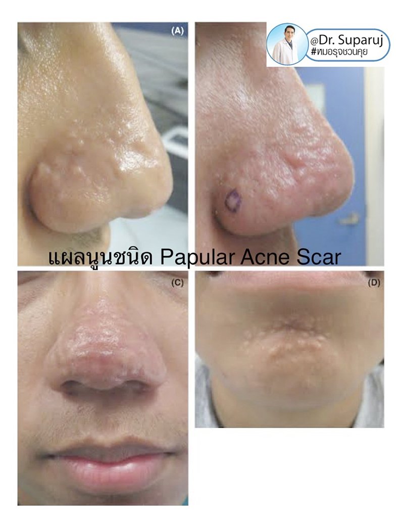 แนะนำเทคนิคดูแลหลุมสิว : แผลเป็นหลุมสิวที่จมูก ดูแลได้อย่างไรบ้าง ? แนะนำเทคนิคดูแลหลุมสิว : แผลเป็นหลุมสิวที่จมูก ดูแลได้อย่างไรบ้าง ?