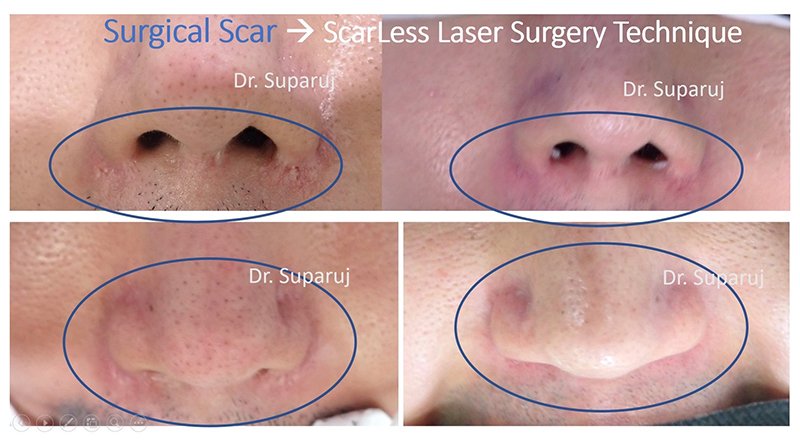 ดูแลแผลผ่าตัด แผลเป็นนูนด้วย ScarLess Laser Surgery Technique