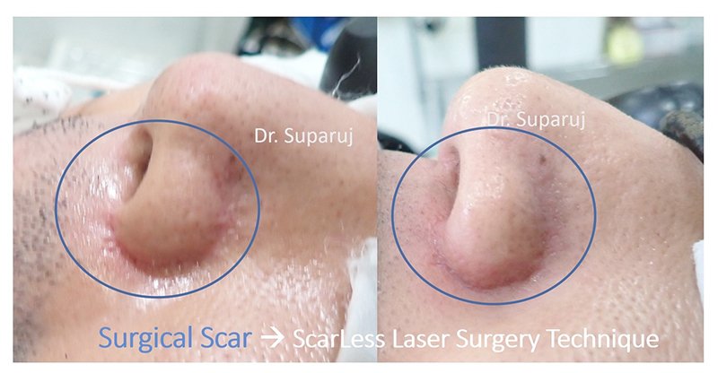 ดูแลแผลผ่าตัด แผลเป็นนูนด้วย ScarLess Laser Surgery Technique