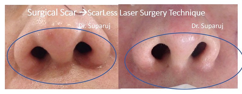 ดูแลแผลผ่าตัด แผลเป็นนูนด้วย ScarLess Laser Surgery Technique ดูแลแผลผ่าตัด แผลเป็นนูนด้วย ScarLess Laser Surgery Technique