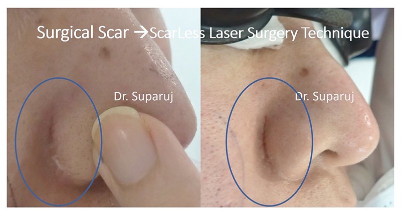 ดูแลแผลผ่าตัด แผลเป็นนูนด้วย ScarLess Laser Surgery Technique ดูแลแผลผ่าตัด แผลเป็นนูนด้วย ScarLess Laser Surgery Technique