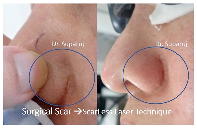 ดูแลแผลผ่าตัด แผลเป็นนูนด้วย ScarLess Laser Surgery Technique