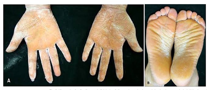 ภาวะเหงื่อออกมาก (Hyperhidrosis) คืออะไร ดูแลได้อย่างไร ภาวะเหงื่อออกมาก (Hyperhidrosis) คืออะไร ดูแลได้อย่างไร