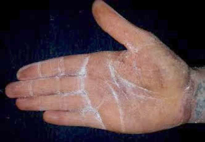 ภาวะเหงื่อออกมาก (Hyperhidrosis) คืออะไร ดูแลได้อย่างไร ภาวะเหงื่อออกมาก (Hyperhidrosis) คืออะไร ดูแลได้อย่างไร