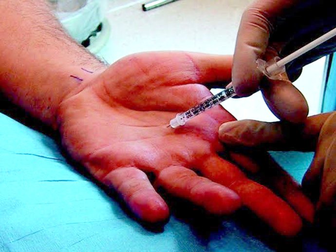 ภาวะเหงื่อออกมาก (Hyperhidrosis) คืออะไร ดูแลได้อย่างไร ภาวะเหงื่อออกมาก (Hyperhidrosis) คืออะไร ดูแลได้อย่างไร