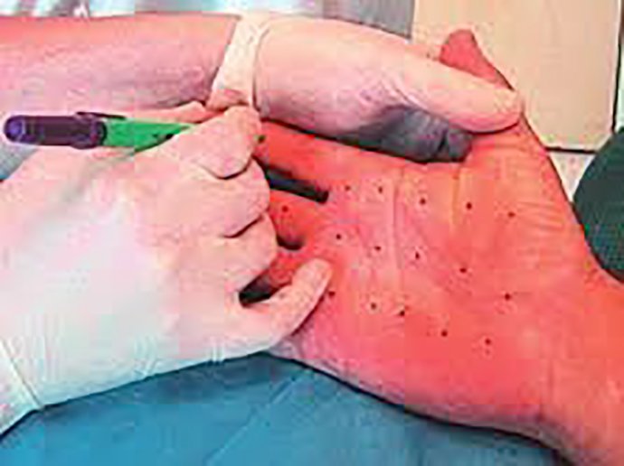 ภาวะเหงื่อออกมาก (Hyperhidrosis) คืออะไร ดูแลได้อย่างไร ภาวะเหงื่อออกมาก (Hyperhidrosis) คืออะไร ดูแลได้อย่างไร