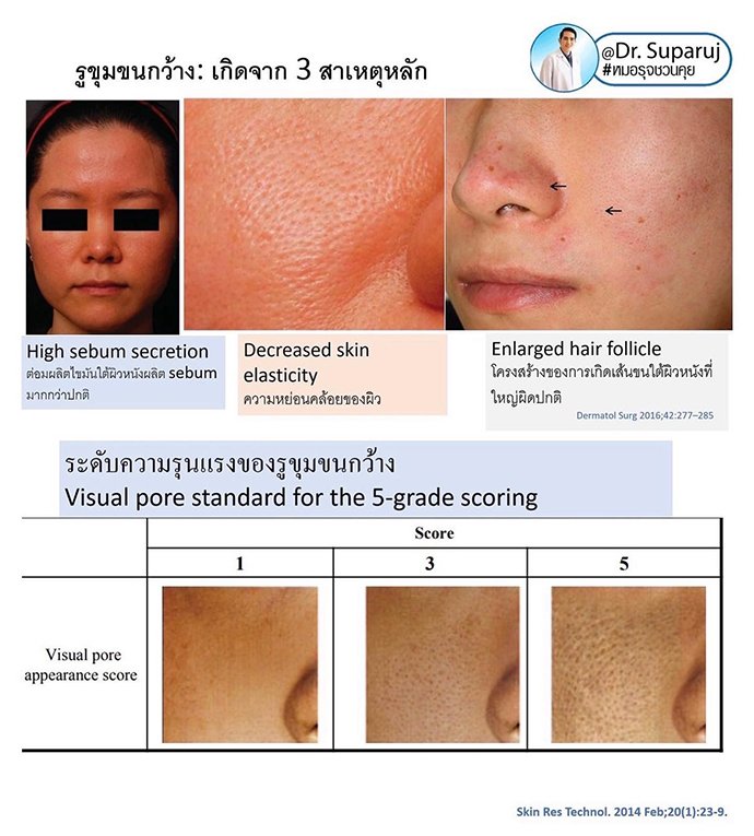 รูขุมขนกว้าง Enlarged facial Pore เกิดจากอะไรดูแลได้อย่างไร Part I ? รูขุมขนกว้าง Enlarged facial Pore เกิดจากอะไรดูแลได้อย่างไร Part I ?