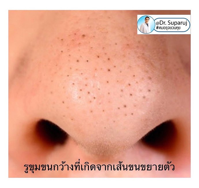 รูขุมขนกว้าง Enlarged facial Pore เกิดจากอะไรดูแลได้อย่างไร Part I ? รูขุมขนกว้าง Enlarged facial Pore เกิดจากอะไรดูแลได้อย่างไร Part I ?