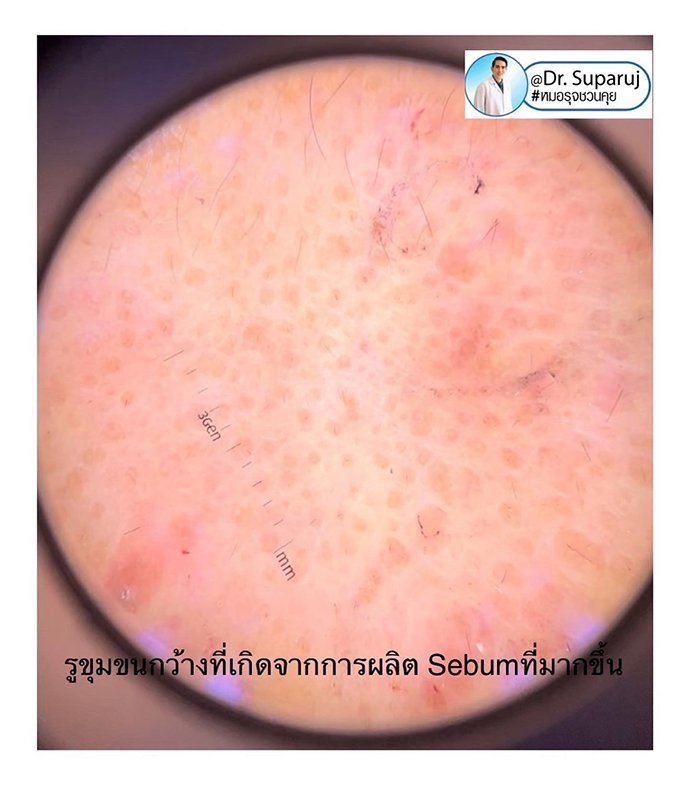 รูขุมขนกว้าง Enlarged facial Pore เกิดจากอะไรดูแลได้อย่างไร Part I ? รูขุมขนกว้าง Enlarged facial Pore เกิดจากอะไรดูแลได้อย่างไร Part I ?