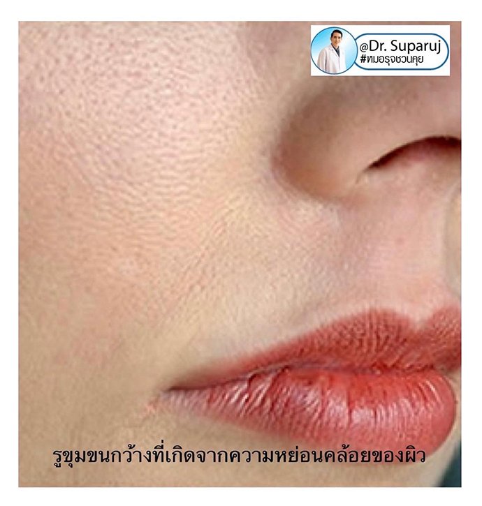 รูขุมขนกว้าง Enlarged facial Pore เกิดจากอะไรดูแลได้อย่างไร Part I ?