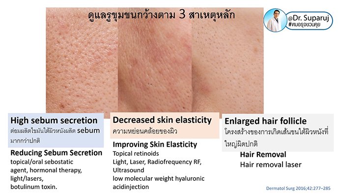 รูขุมขนกว้าง Enlarged Facial Pore ดูแลได้อย่างไร Part II? รูขุมขนกว้าง Enlarged Facial Pore ดูแลได้อย่างไร Part II?รูขุมขนกว้าง Enlarged Facial Pore ดูแลได้อย่างไร Part II?