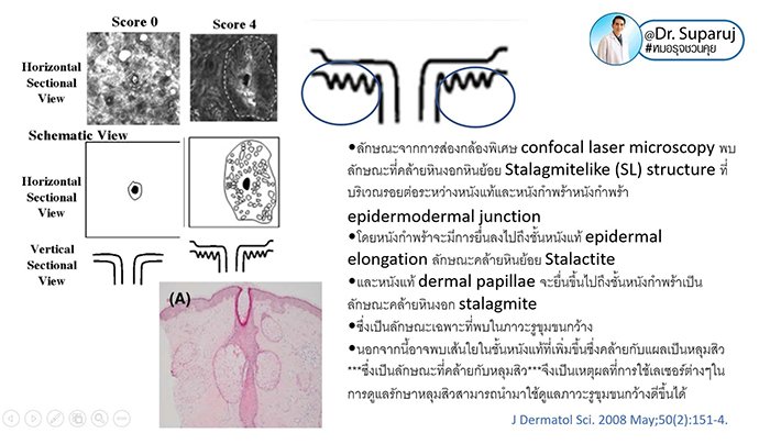 รูขุมขนกว้าง Enlarged Facial Pore ดูแลได้อย่างไร Part II? รูขุมขนกว้าง Enlarged Facial Pore ดูแลได้อย่างไร Part II?