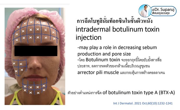 รูขุมขนกว้าง Enlarged Facial Pore ดูแลได้อย่างไร Part II? รูขุมขนกว้าง Enlarged Facial Pore ดูแลได้อย่างไร Part II?