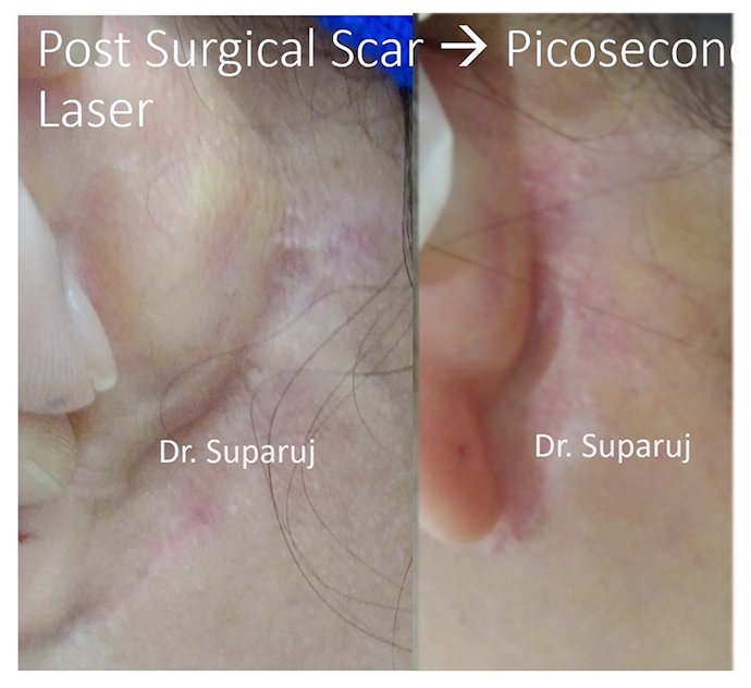 ดูแลแผลเป็นยุบตัวจากอุบัติเหตุ Traumatic/ Atrophic scar ได้อย่างไรบ้าง?