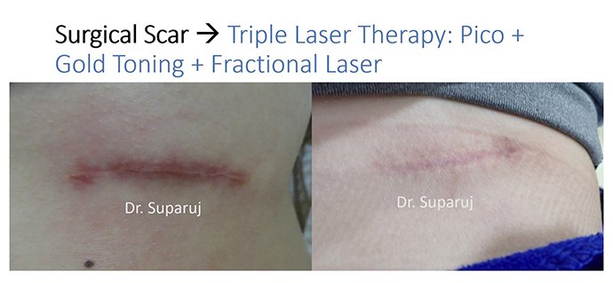 ดูแลแผลเป็นยุบตัวจากอุบัติเหตุ Traumatic/ Atrophic scar ได้อย่างไรบ้าง? ดูแลแผลเป็นยุบตัวจากอุบัติเหตุ Traumatic/ Atrophic scar ได้อย่างไรบ้าง?